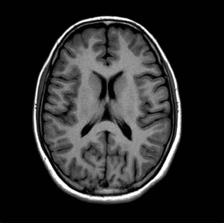 What is T1w in MRI?