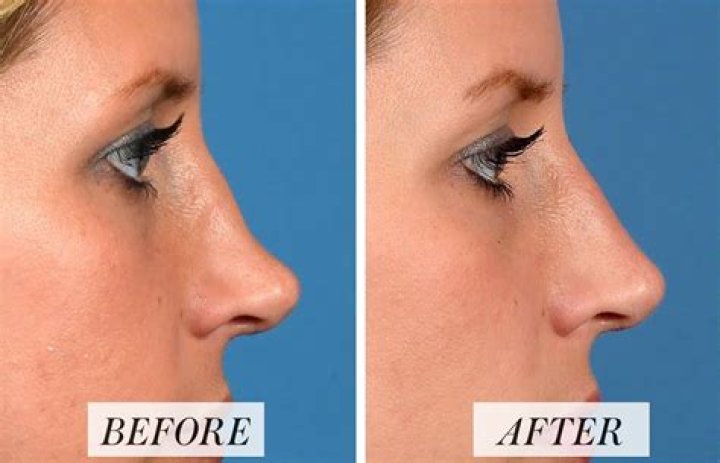 What is the nose job procedure?