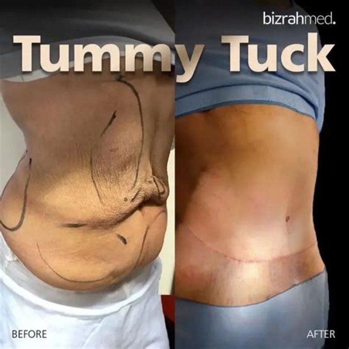 What qualifies you for a tummy tuck?